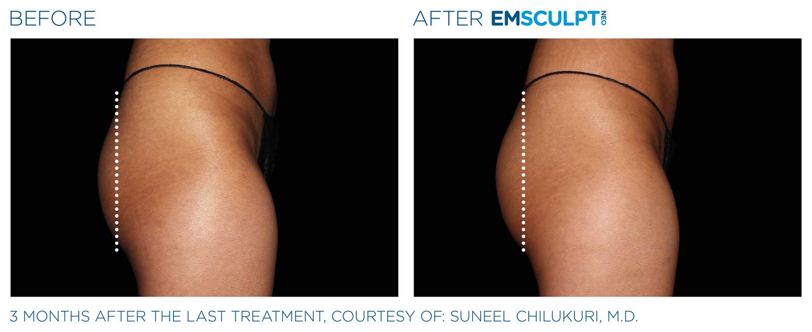 Emsculpt_Neo_PIC_Ba-card-female-buttock-075_ENUS100 after emsculpt
