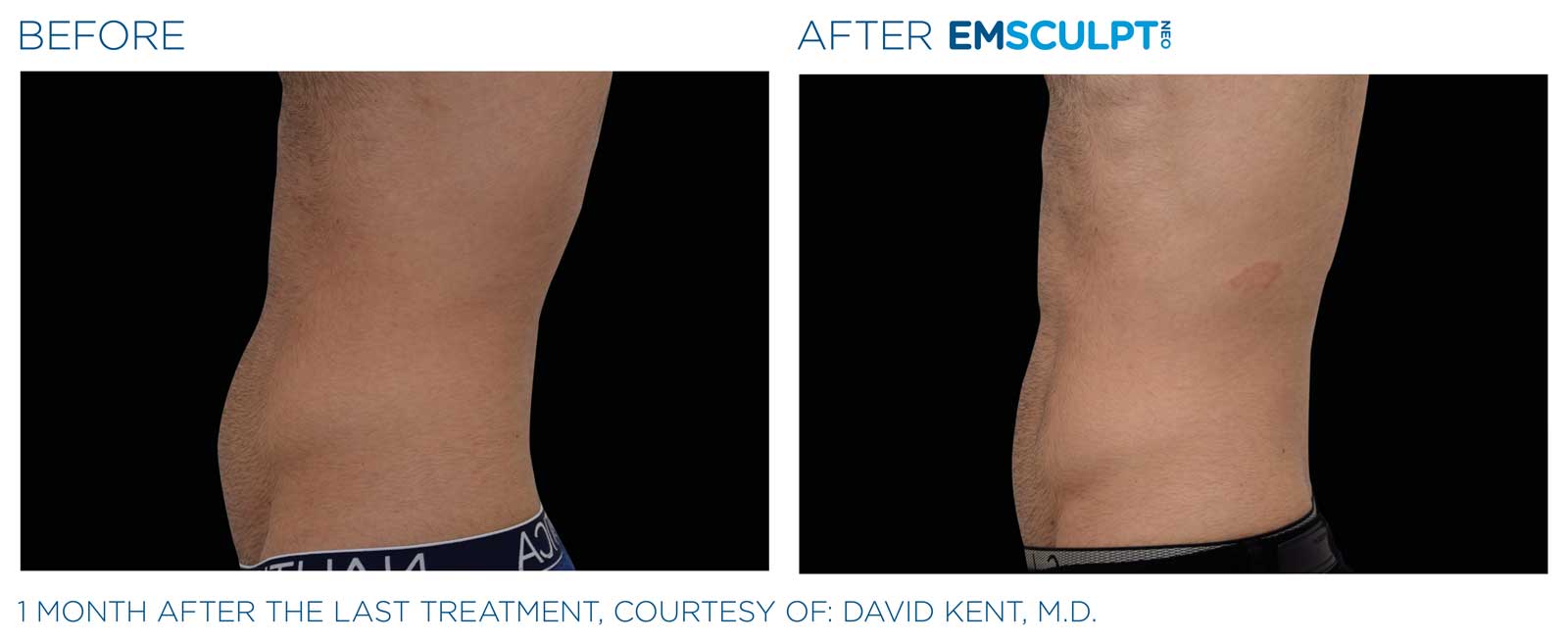 Emsculpt_neo_PIC_Ba-card-male-abdomen-021_ENUS100 emsculpt contouring evergreen