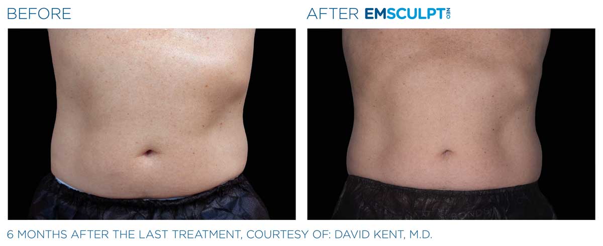 Emsculpt_neo_PIC_Ba-card-male-abdomen-043_ENUS100 emsculpt contouring evergreen