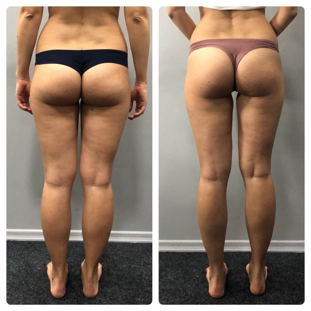 butt coolsculpting evergreen
