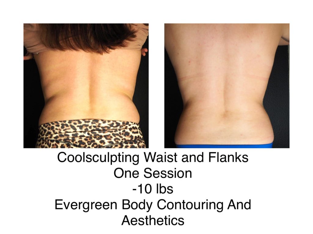 coolsculpting Evergreen