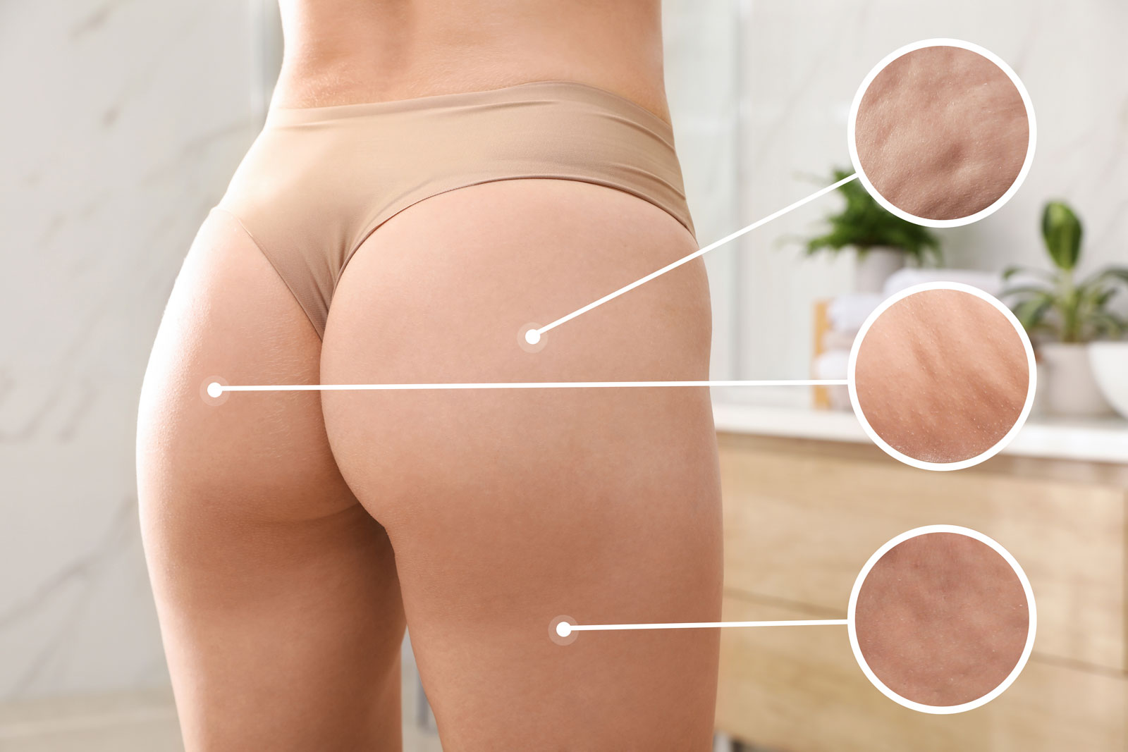 cellulite treatment evergreen