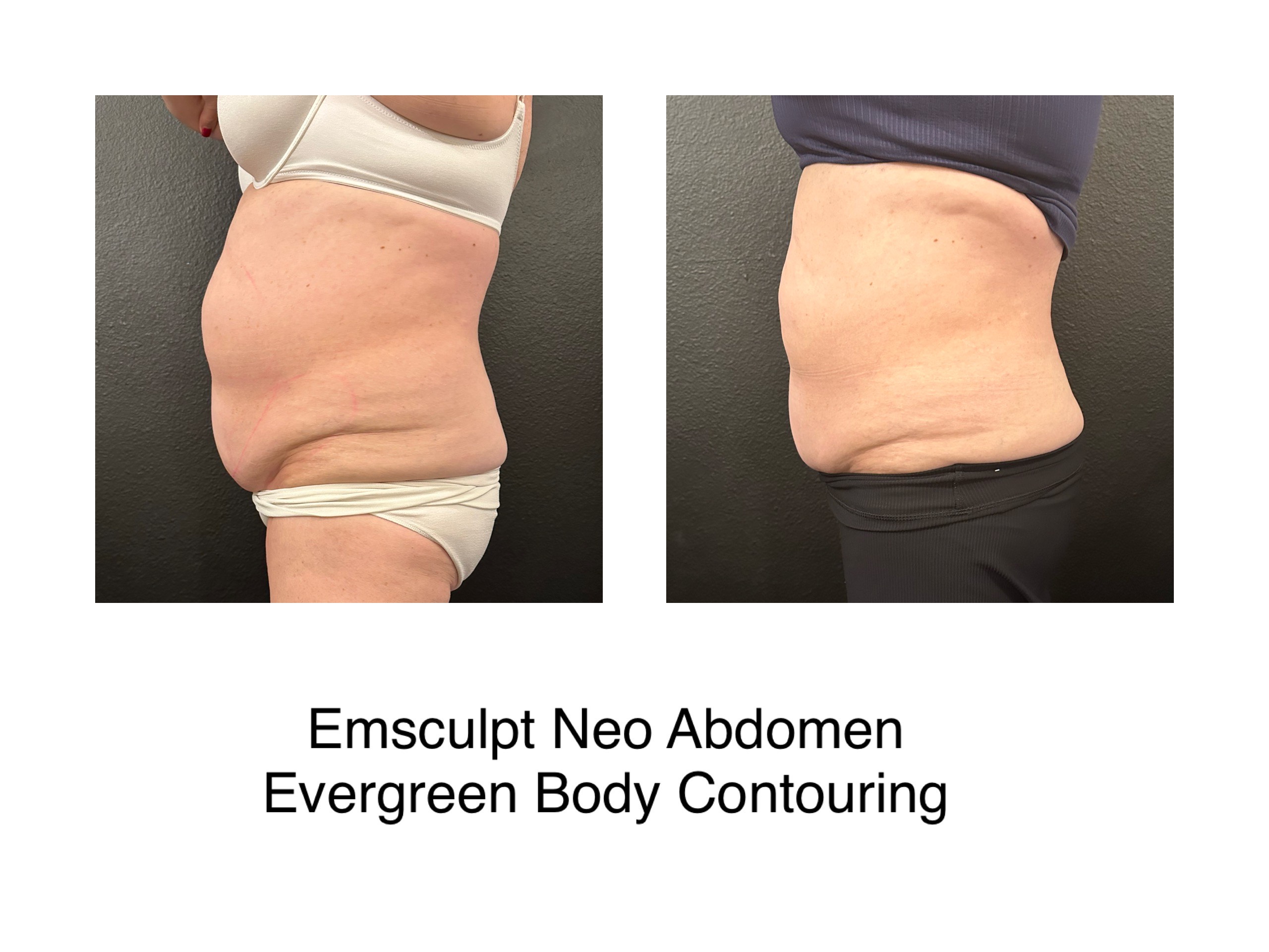 image_6483441 (10) emsculpt neo before and after