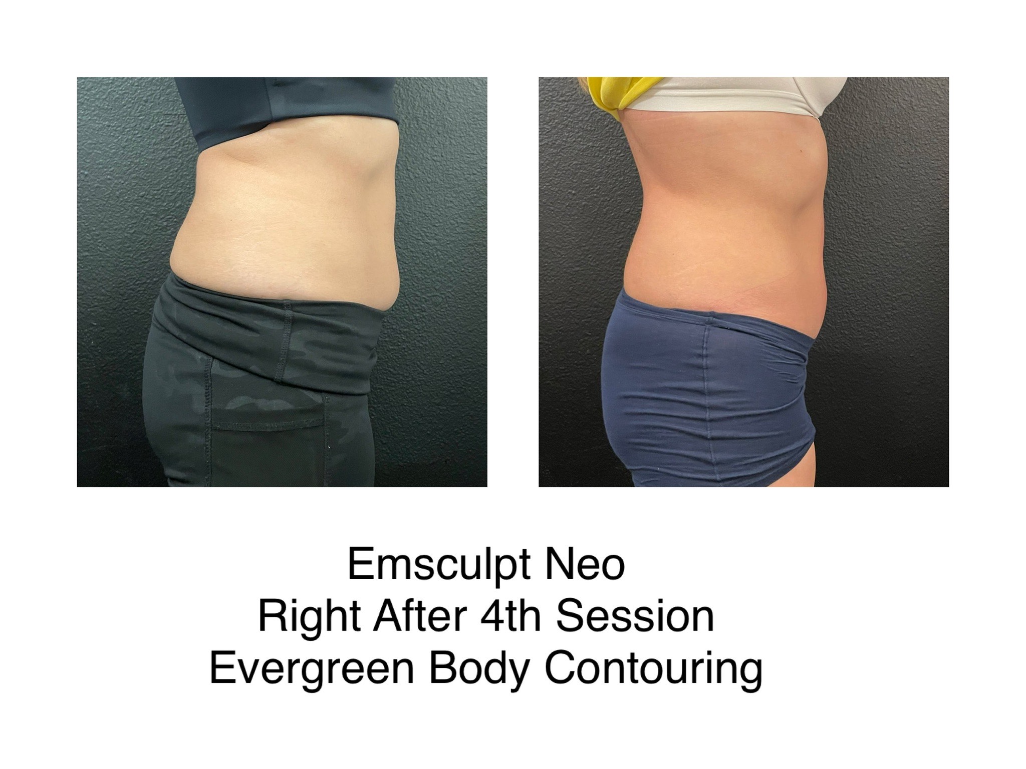 image_6483441 (11) emsculpt neo before and after
