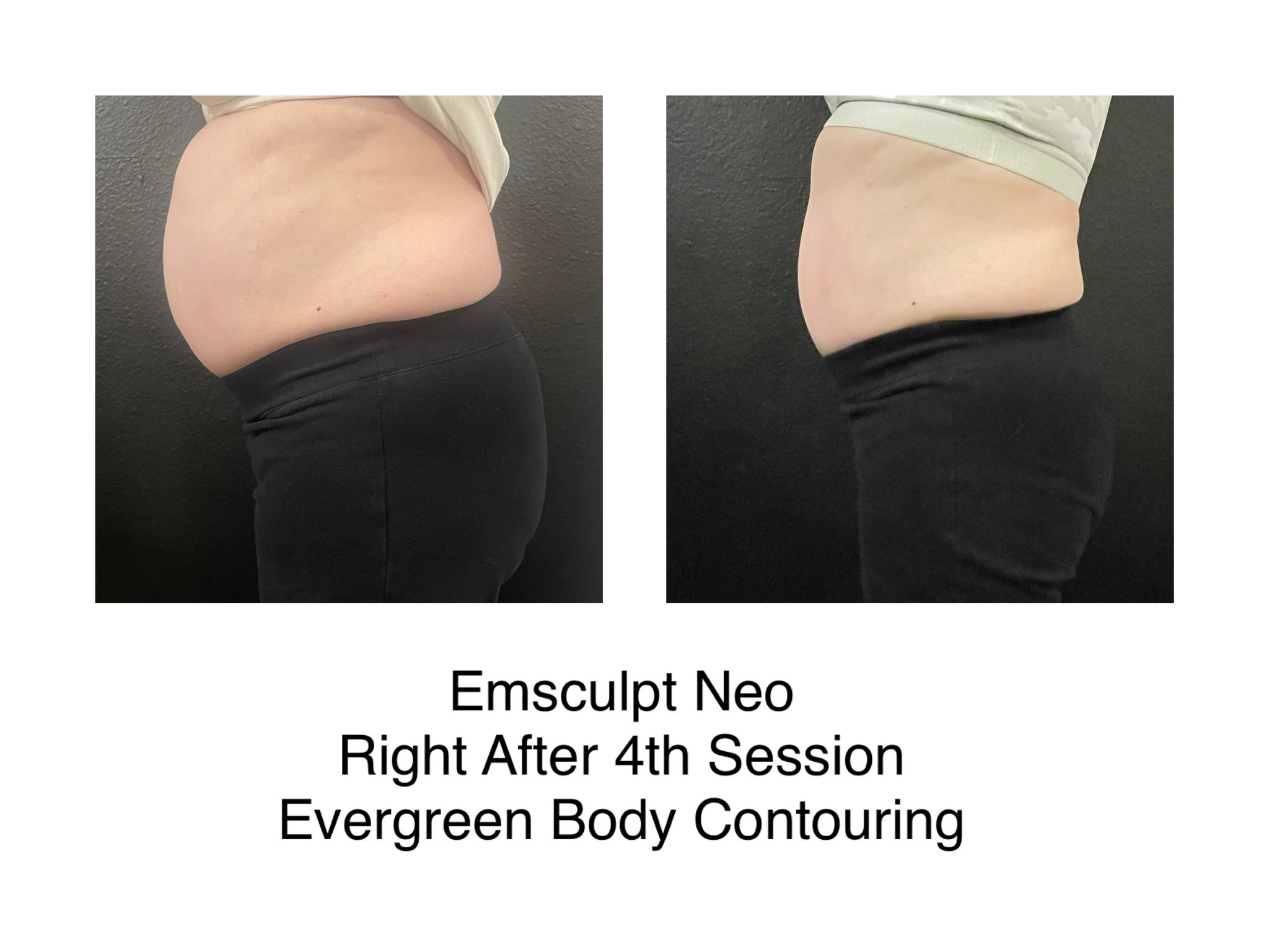 image_6483441 (12) emsculpt neo before and after