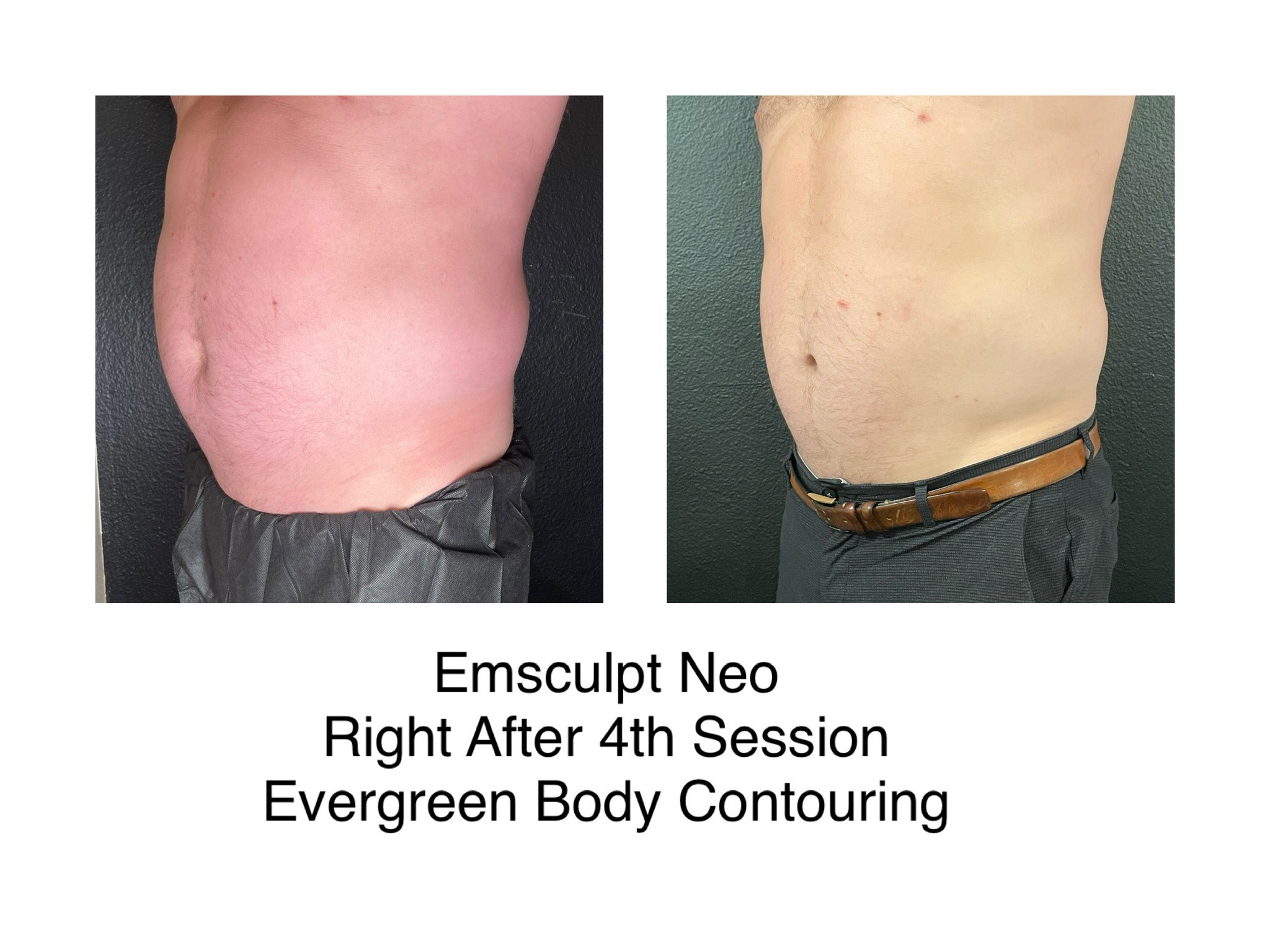 image_6483441 (15) emsculpt neo before and after