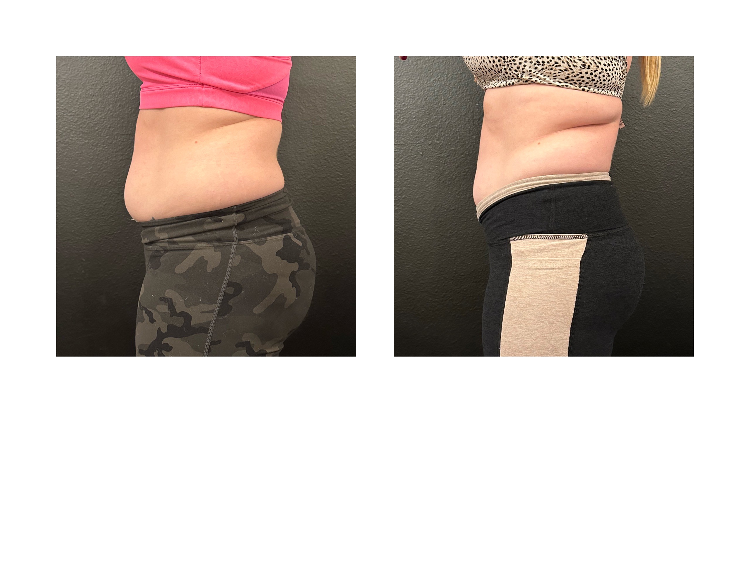 image_6483441 (7) emsculpt neo before and after